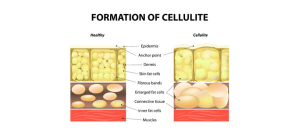 Formation of Cellulite